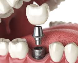 Floss Dental Implant Dentistry in Delhi