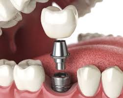 Implant Dentistry