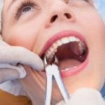 How To Sleep After Tooth Extraction
