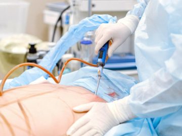 Abdominoplasty Surgery
