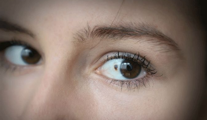 What is eye melanoma?