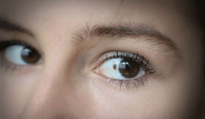 eye melanoma