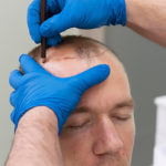 Hair Transplantation in Istanbul