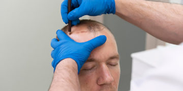 Hair Transplantation in Istanbul