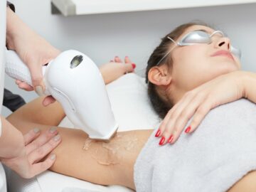 Laser Hair Removal