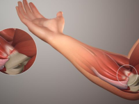 Tendonitis Treatment
